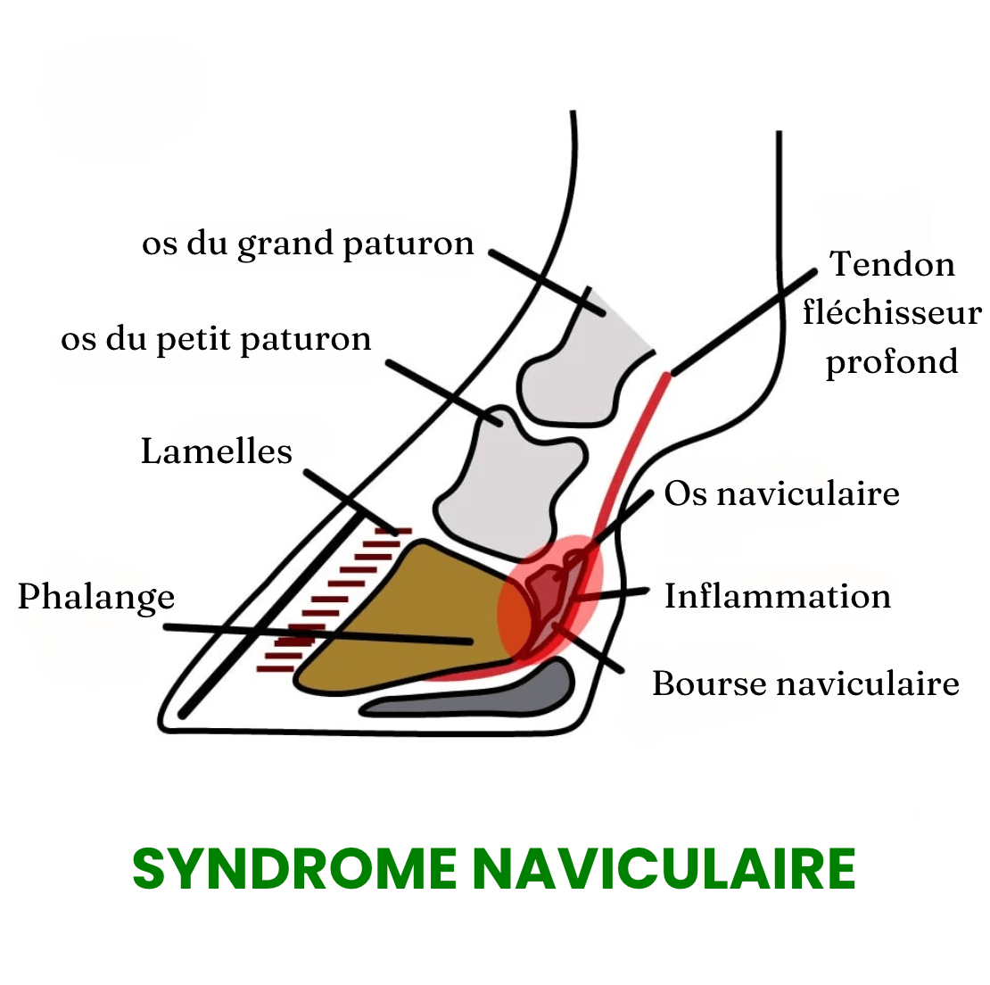 Sch&eacute;ma du syndrome naviculaire