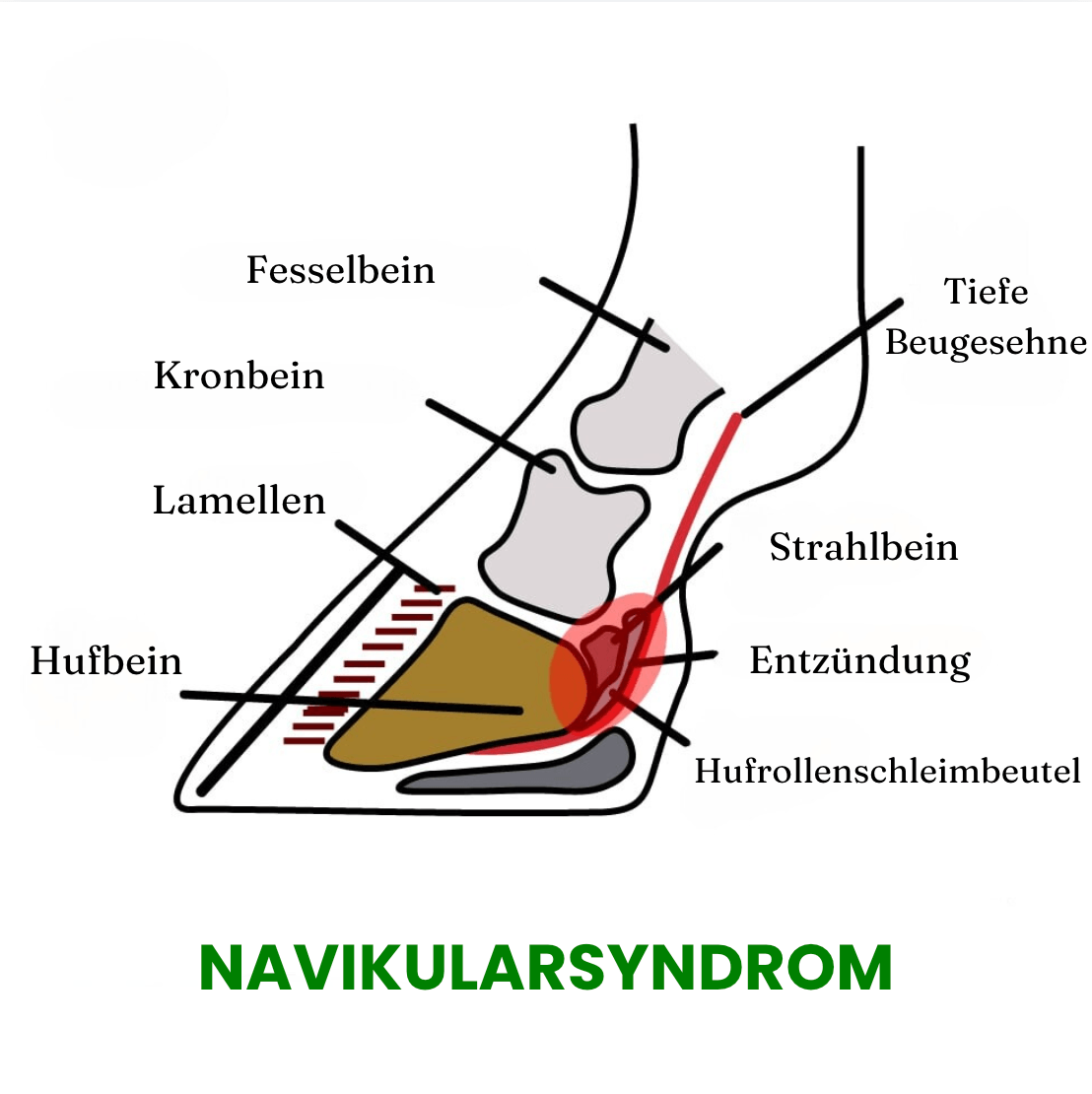 Sch&eacute;ma du syndrome naviculaire